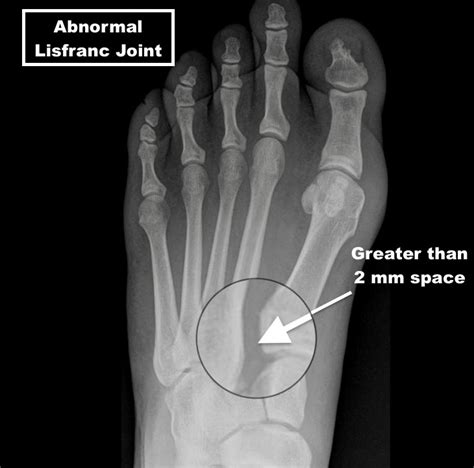 Lisfranc Injury - A Matter of a Few Millimeters