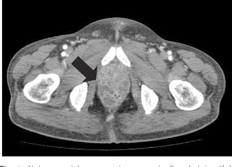 Figure 2 from Successful Treatment of Prostatic Abscess Accompanied by Methicillin-Resistant ...