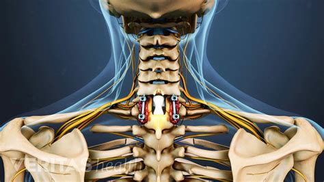 A Step-by-Step Guide to Cervical Laminectomy Surgery