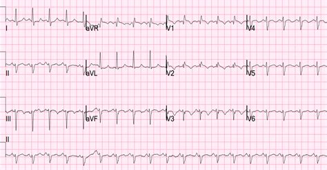 Dr. Smith's ECG Blog: Dyspnea on Exertion and a Positive Troponin