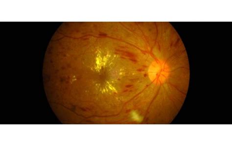 Macular Edema: Causes, Symptoms, Treatment | OBN