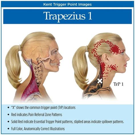 Trapezius 1 trigger point | Acupressure | Pinterest