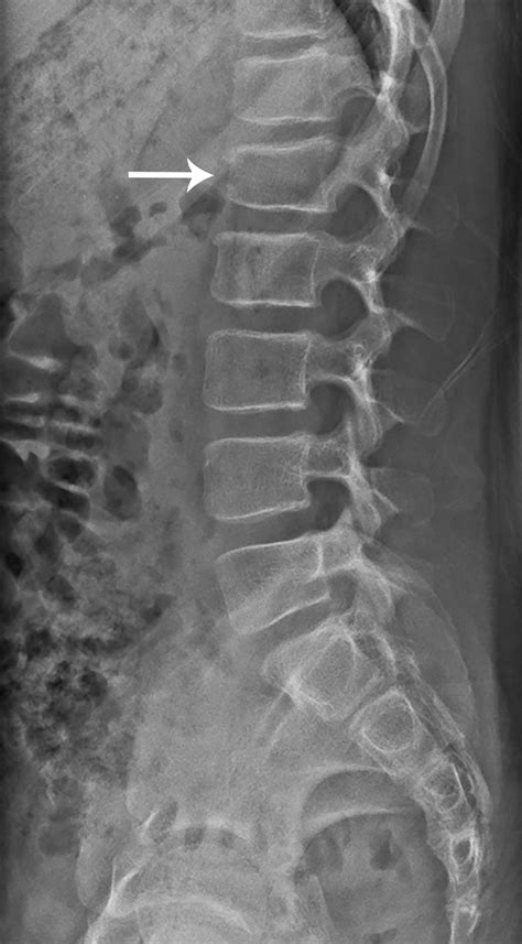 My achin’ back: Vertebral compression fractures | Radiology Key