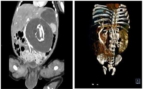 Fetus in fetu: A case report and literature review Abstract