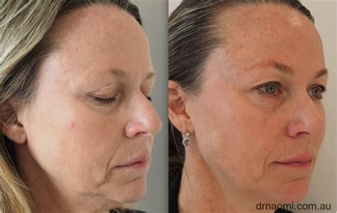 Dermal Filler for Jowls and Marionette Folds - Best Cosmetic Clinic ...