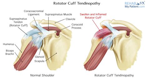 acquaintance Mount Vesuvius pivot rotator cuff tendinopathy Dent Variety Hong Kong