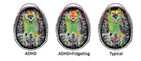 Study’s MRI images suggest fidgeting good for ADHD brain | New Zealand Doctor