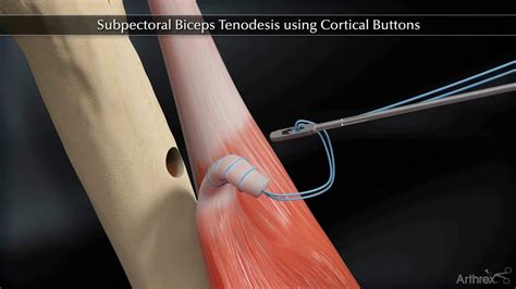 Biceps Tenodesis Recovery Time | Renew Physical Therapy