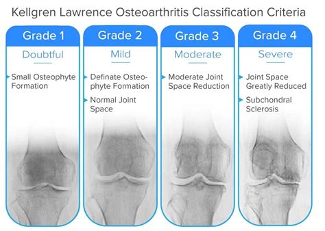 My Doctor Says I Have Mild Knee Osteoarthritis