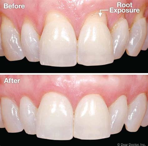 Gum Recession | Periodontal Disease Treatment Houston TX