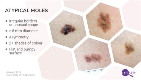 About Moles - Types, Warning Signs, Causes, and Prevention