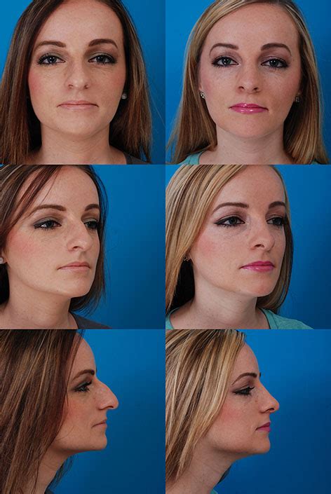 B&A Rhinoplasty (Nose) - Swanson Center for Cosmetic Surgery