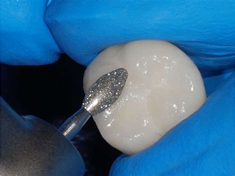 Polishing Zirconia - Burbank Dental Lab