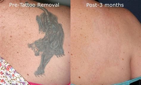 Picosure Laser Tattoo Removal by San Diego Dermatologists