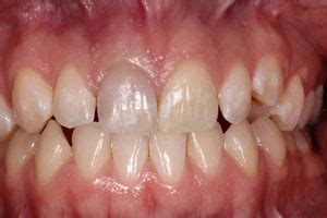 Internal Bleaching Before & After Pictures Concord NH | Smile Gallery