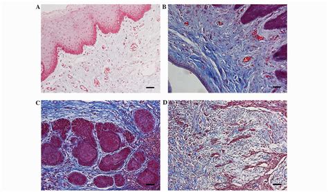 Distribution and significance of interstitial fibrosis and stroma ...