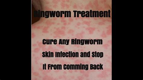 What is Ringworm - What Is Ringworm - Causes, Symptoms and Treatment ...