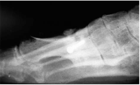 Hallux Limitus and Hallux Rigidus | Musculoskeletal Key