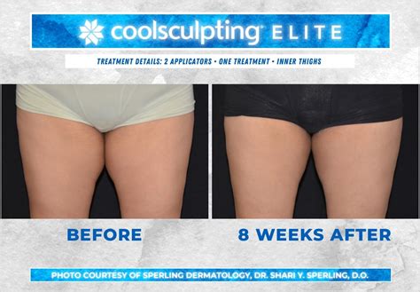 Before and After CoolSculpting Photos