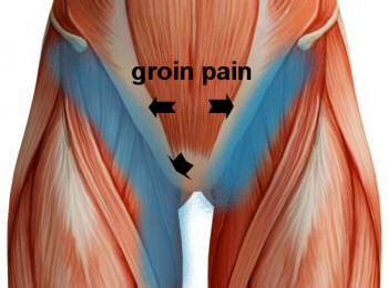 Groin Pain, Groin Strain Treatment. Upper Thigh Pain, Hip Pain, Hernia ...