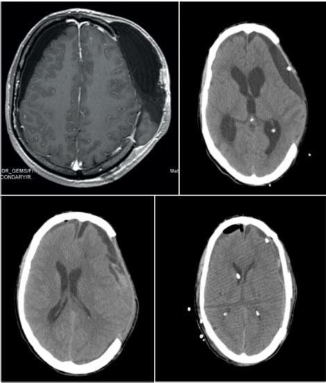 Complications of decompressive craniectomy in neurological emergencies