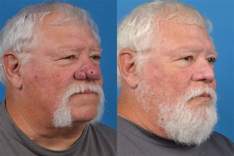 Rhinophyma | Melbourne, FL | Patient 29296