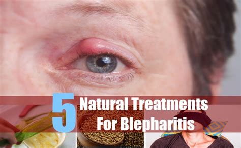 5 Natural Cures For Blepharitis - Natural Treatment And Cure For ...