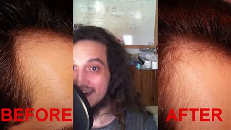 Finasteride Ru58841 And Minoxidil 10 Years Later Before After Results – Otosection