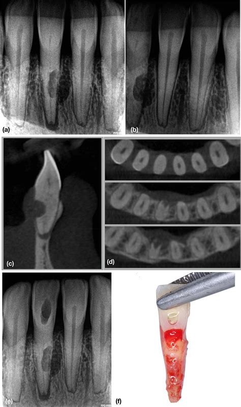 Management of an external root resorption with intentional... | Download Scientific Diagram