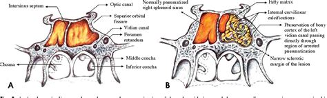 Figure 2 from Arrested pneumatization of the sphenoid sinus mimicking intraosseous lesions of ...