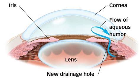 Treatment for Glaucoma with Laser Iridotomy (Video) | South Bay Ophthalmology