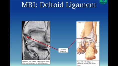 Deltoid Ligament - YouTube