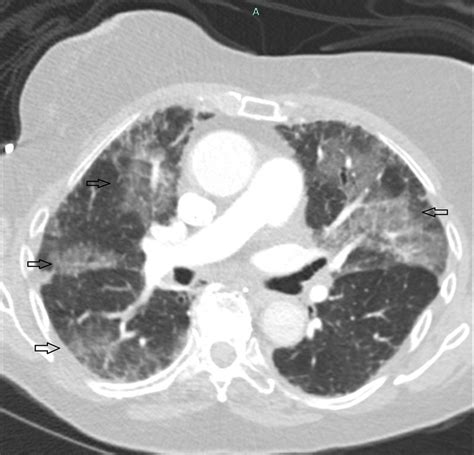 Contrast CT scan chest. | Download Scientific Diagram