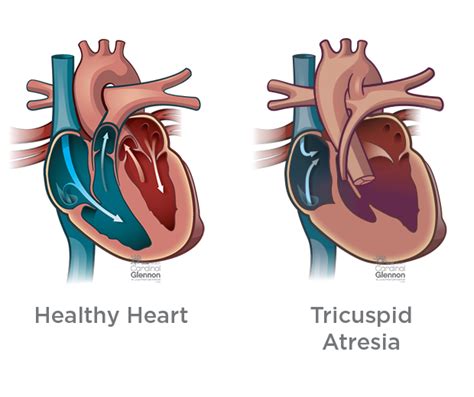 Hypoplastic Right Heart Syndrome Survival Rate - Quotes Viral Update