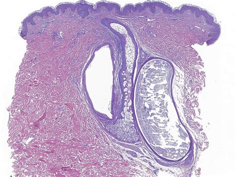 VIRTUAL GRAND ROUNDS IN DERMATOLOGY 2.0: Vellus Hair Cysts