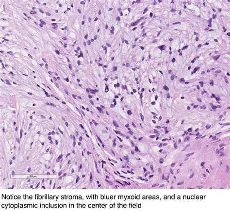 Pathology Outlines - Dermal nerve sheath myxoma