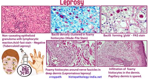 Pathology of Leprosy - Dr Sampurna Roy MD