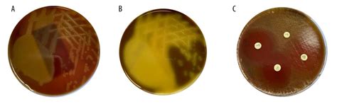 American Journal of Case Reports | Viridans Group Streptococcus ...