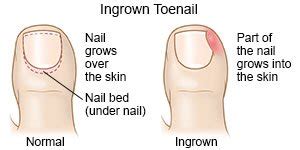 Partial Nail Avulsion for Ingrown Nail - What You Need to Know