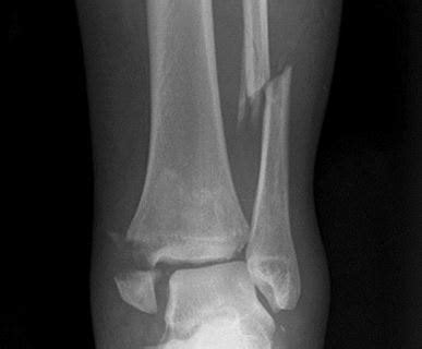 Fibula Fracture - Types, Recovery, Causes, Symptoms, Distal, Proximal