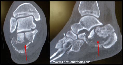 Calcaneal Fractures - FootEducation