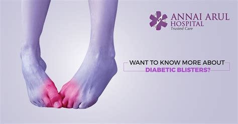 WANT TO KNOW MORE ABOUT DIABETIC BLISTERS? – Multispeciality Hospitals ...