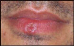 Cutaneous Manifestations of Syphilis | SpringerLink