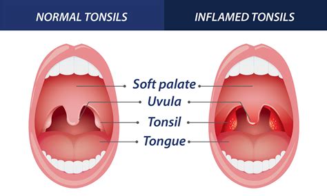 Viral Inflamed Tonsils