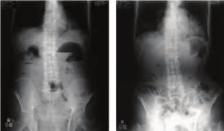 Abdominal X-ray radiographs of a 95-year-old paralytic ileus patient.... | Download Scientific ...