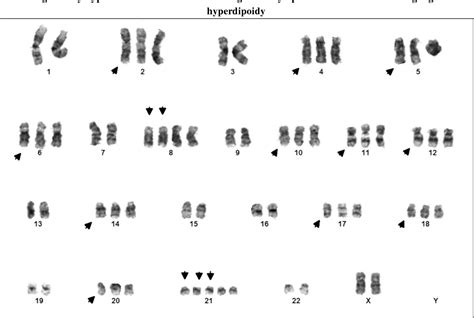 Routine Cytogenetic Analysis of Chromosome Abnormalities in Acute Lymphoblastic Leukemia ...