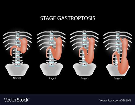 Gastroptosis stomach the omission stomach Vector Image