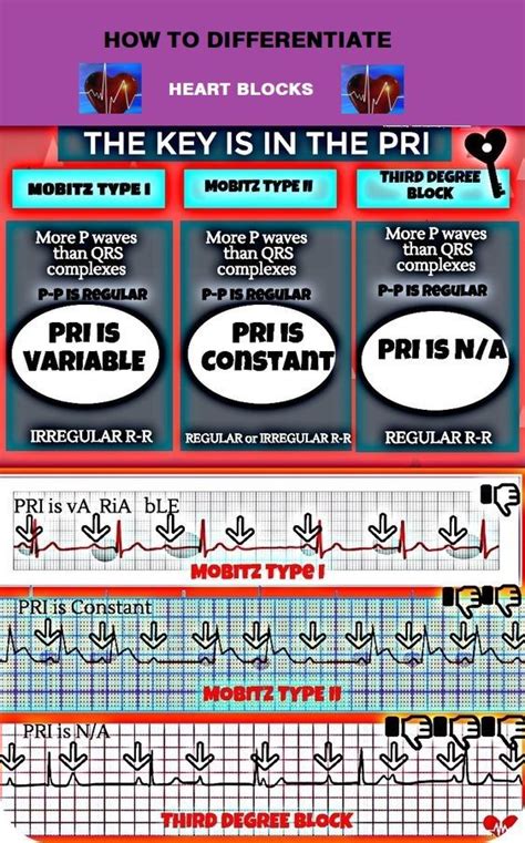 heart-blocks | Icu nursing, Critical care nursing, Paramedic school