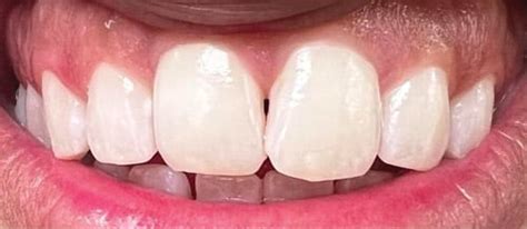 Managing Enamel Demineralization - Dimensions of Dental Hygiene