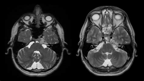 Positive Patient Outcomes With Minimally Invasive Skull Base Surgery ...